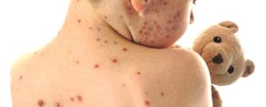 Morbillo: Calabria e Sicilia le regioni più colpite, il 93% dei casi su pazienti non vaccinati item-thumbnail